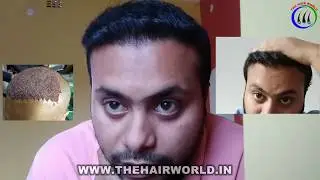 Hair Transplant Results || Case Study 10 Months Result || Best Result Of FUE Hair Transplant Results