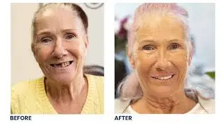 Patient Experience at Banning Dental Group - Maryon Flin (Dental Implants)