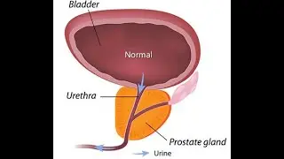 Benign Prostatic Lesions & Mimickers of Prostatic Carcinoma