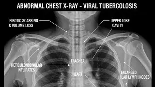 chest x-ray how to read chest x-ray #chest #xray #radiology #copd #mbbs #medical updates part 2