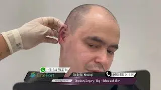 Incredible Ear Transformation! Full Otoplasty Surgery & Patient Reaction