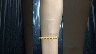 let's Cover Your Unwanted Scars or Tattoo With Experts #shorts #youtubeshorts #new #scar