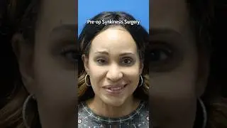 Synkinesis surgery 5.5 years follow-up #facialparalysis #synkinesis #selectiveneurolysis
