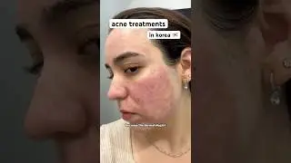 destroying my oil glands by laser ￼#Korea #Acne