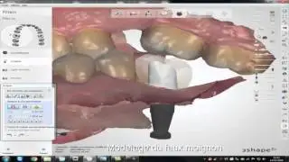 Dr DUMINIL / Empreinte optique et proth&egrave;se implanto-port&eacute;e / Vid&eacute;o 2