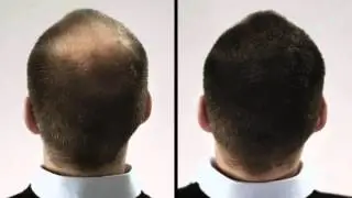 Haarstreu Streuhaar Haardicht - Hairmaker - Wie es funktioniert