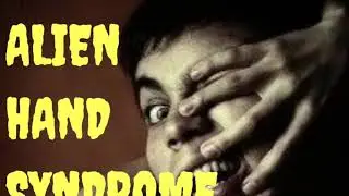 Alien hand Syndrome