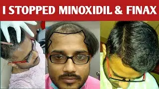 Stop minoxidil and finasteride | Hair heal talks.