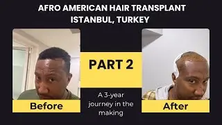 Part 2: Operation Day-Hair Transplant in Istanbul, Turkey
