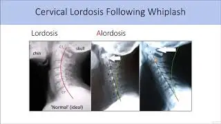 Foward Head Posture: Cause & Cure : Flat Neck Curve