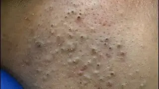 Deep Cleansing For Acne &mdash; Effective Blackhead And Pimple Solutions