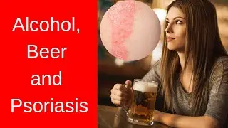 Psoriasis and Alcohol : Everything you need to know