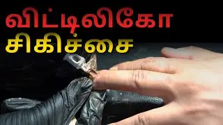 விட்டிலிகோ சிகிச்சை | பக்க விளைவுகள் இல்லை | Machu Tattoos | Bangalore | Hyderabad | Chennai