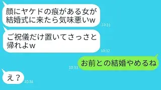 顔に火傷の跡がある妹を見下して、結婚式から追い出そうとした姉の婚約者「醜い女は出て行け」→優しい姉が激怒し、結婚式が大混乱にwww