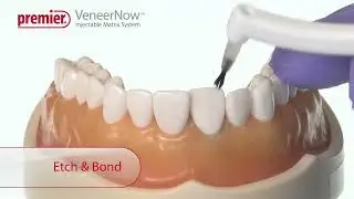 VeneerNow&trade; Injectable Matrix System - For Misaligned Teeth