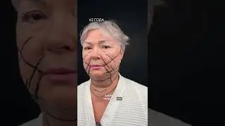 The Transformation of Victoria at 62: Complex Rejuvenation Results     @SurgicalGlam