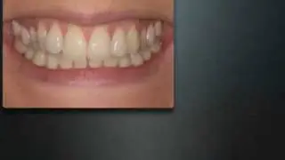 Inman Aligner before and after