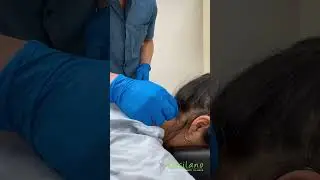 Acupuncture
