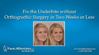 Fix the Underbite without Orthognathic Surgery in Two Weeks or Less
