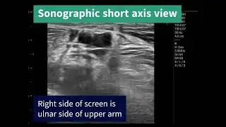 Sonographic view of upper extremity venous valve