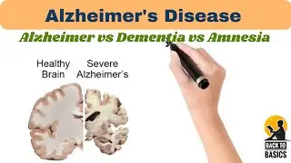 Alzheimer's Disease, difference between Alzheimer, dementia and amnesia