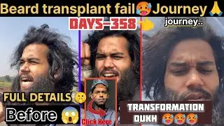 Days-358 Beard Transplant Fail😱🔥|| Result Condition Journey 🙏
