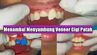 Menambal Gigi Depan Yang Patah Sebagian Karena Terjatuh di Puskesmas