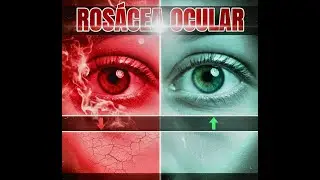 Rosacea Ocular y Tipos de rosacea