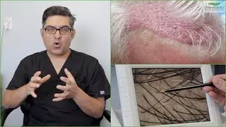 Am I A Good Hair Transplant Candidate?