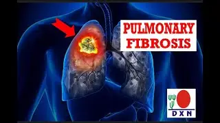 How to treat a Pulmonary fibrosis with Ganoderma & Cordyceps? (Tratamiento de Fibrosis pulmonar)