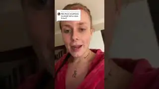 Transgender patient after FUE hair transplant