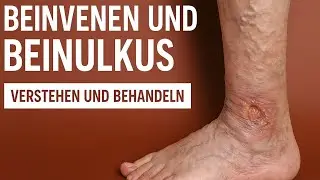 Varikose [Krampfadern] Ulcus cruris Venosum