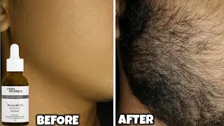 Best minoxidil for beard growth | man matters minoxidil review | beard growth tips 2025 | minoxidil