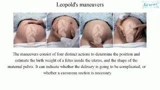 Leopold's maneuvers