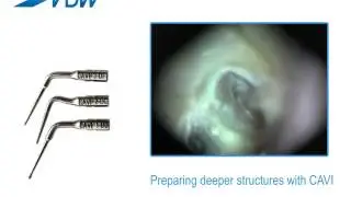 VDW Dental &middot; How To: VDW.ULTRA - Preparing deeper structures with CAVI