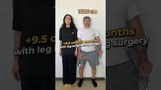 Before and After: From 163.5 cm to 173 cm with Leg Lengthening Surgery #shorts
