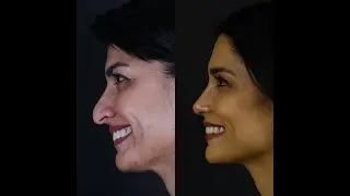 Droopy Tip Nose Job | Planning to Long Term Results