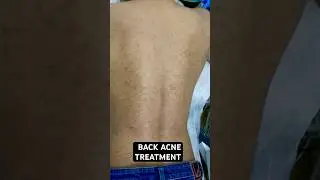Back acne treatment #chemicalpeel #pigmentation #acne #pih #acnetreatment  #skincare #skintreatment