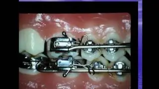 &ldquo;Big Daddy&rdquo; arch wire: Its use in orthodontics , first phase