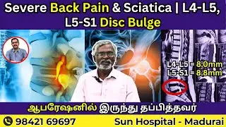 Severe Back Pain & Sciatica | L4-L5, L5-S1 Disc Bulge ஆபரேஷனில் இருந்து தப்பித்தவர் | Sun Physio