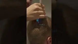 Greffe de cheveux İstanbul | Turkisme Medical #shorts #greffedecheveuxdhı