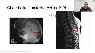 Szpiczak mnogi - objawy, leczenie, występowanie Dr n. med. Damian Mikulski III Warsztaty Edukacyjne