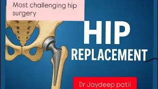 &ldquo;From Disability to Walking Again: Complex Hip Replacement in fracture dislocation of hip&rdquo;