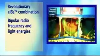 Lisa Benest, MD: Look Younger with Refirme