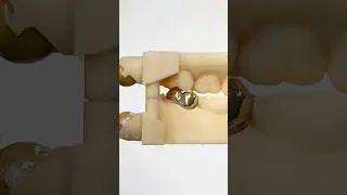 14Kt Gold Crown @EnvisiontecMain #envisiontec #lsk121shorts #dentist #teeth