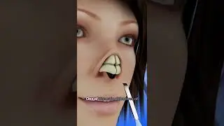 Измените свой нос с помощью ринопластики #шорты - Creativelearning3d