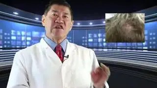 Psoriasis | cigarettes psoriasis connection
