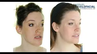 Cirugía ortognática  bimaxilar. Caso #1: Claudia - Clase 3