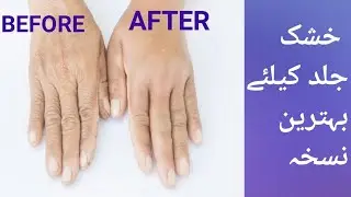 Quick Solution for Dry and Wrinkled Hands and Feet.#beauty.health