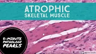 Pitfall Alert!!! Atrophic Skeletal Muscle Can Be Tricky! 5-Minute Pathology Pearls